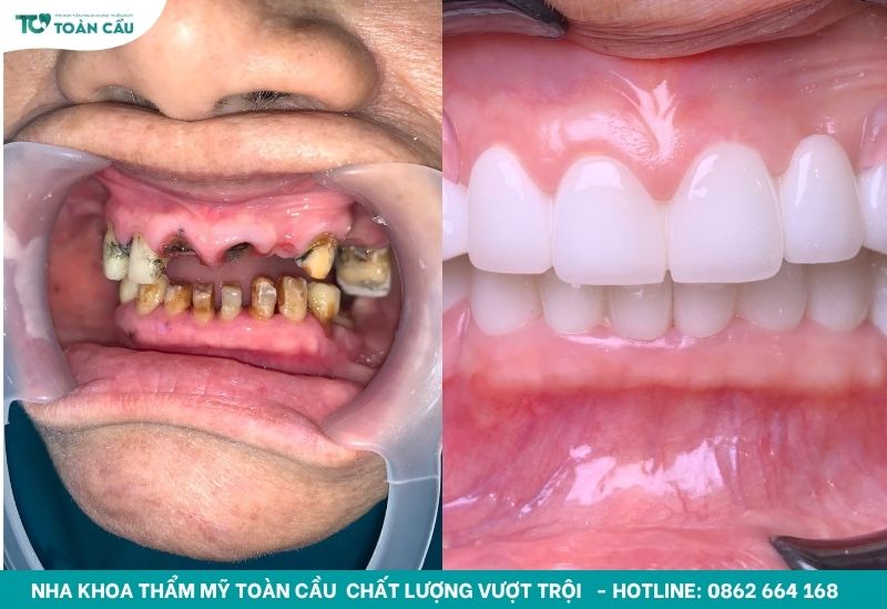 Địa chỉ nha khoa làm răng sứ đẹp tự nhiên tại TPHCM 8 Hình ảnh before - after