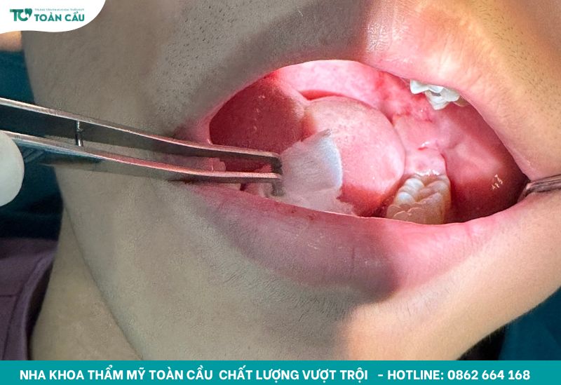 Nha khoa nhổ răng khôn uy tín ở đâu tại TPHCM? 2 Nhổ răng khôn