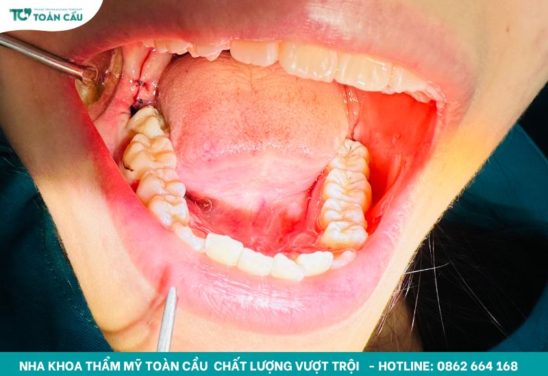 Nha khoa nhổ răng khôn uy tín ở đâu tại TPHCM? 5 Địa chỉ nha khoa nhổ răng khôn uy tín tại HCM