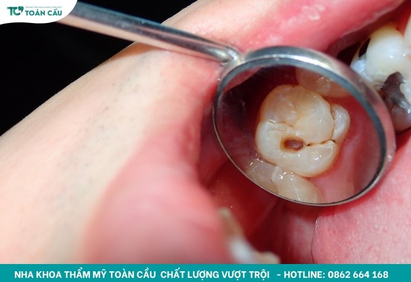Gợi ý nha khoa trám răng uy tín TPHCM cho nụ cười bền đẹp 2 Trám răng điều trị sâu răng