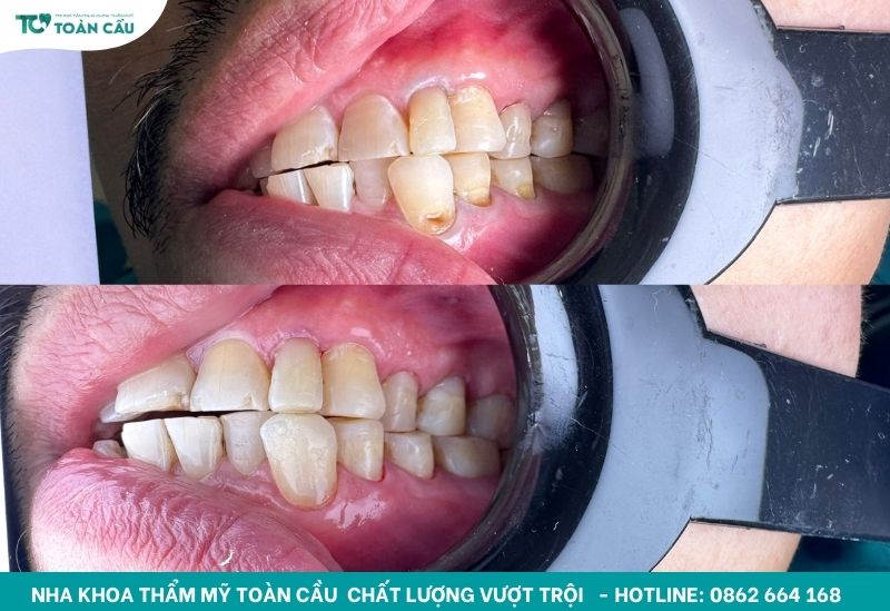 Gợi ý nha khoa trám răng uy tín TPHCM cho nụ cười bền đẹp 5 Kết quả trám răng tại Toàn Cầu
