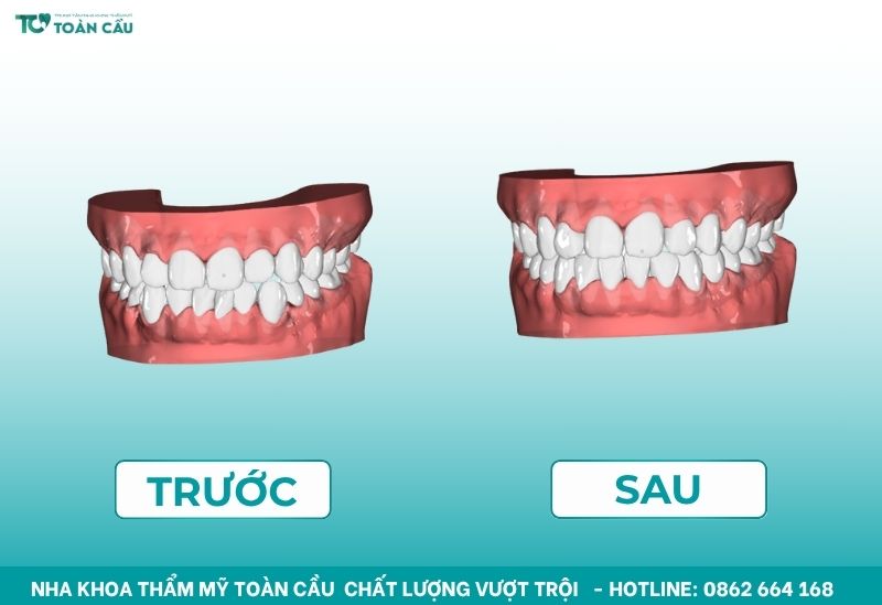 Hình ảnh niềng trong suốt 3D tại Toàn Cầu