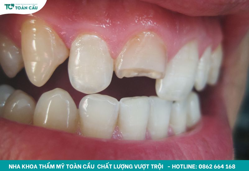 Răng bể có trám được không và nên xử lý ra sao? 2 Răng bị bể nặng