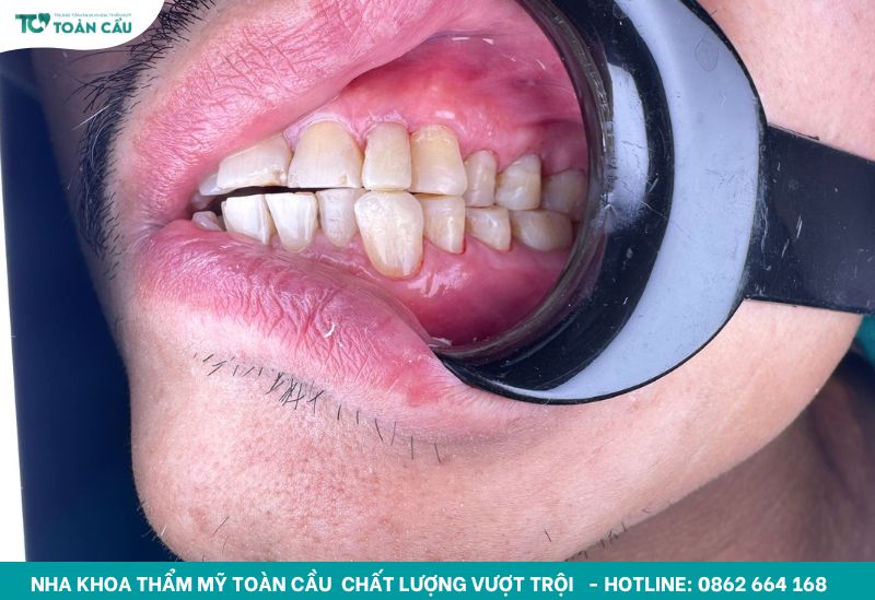 Răng bể có trám được không và nên xử lý ra sao? 3 Trám răng tại Toàn Cầu