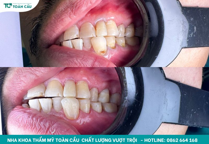Răng bể có trám được không và nên xử lý ra sao? 6 Kết quả trám răng tại Nha khoa Thẩm mỹ Toàn Cầu