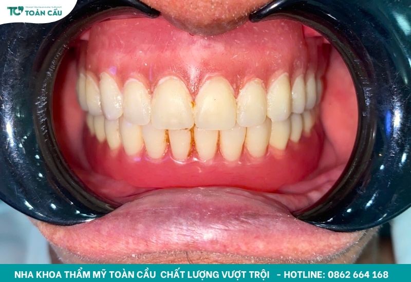 Mách bạn 5 lý do nên chọn răng tháo lắp composite 3 Hàm tháo lắp