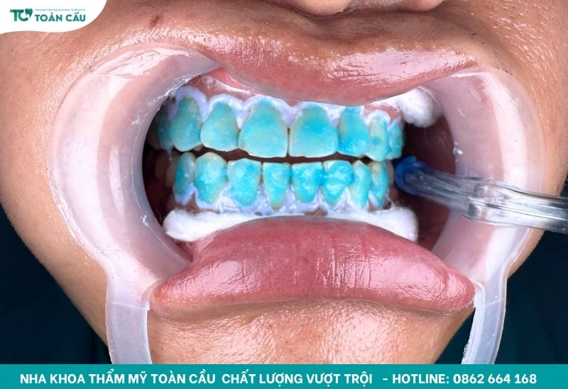 Tẩy trắng răng