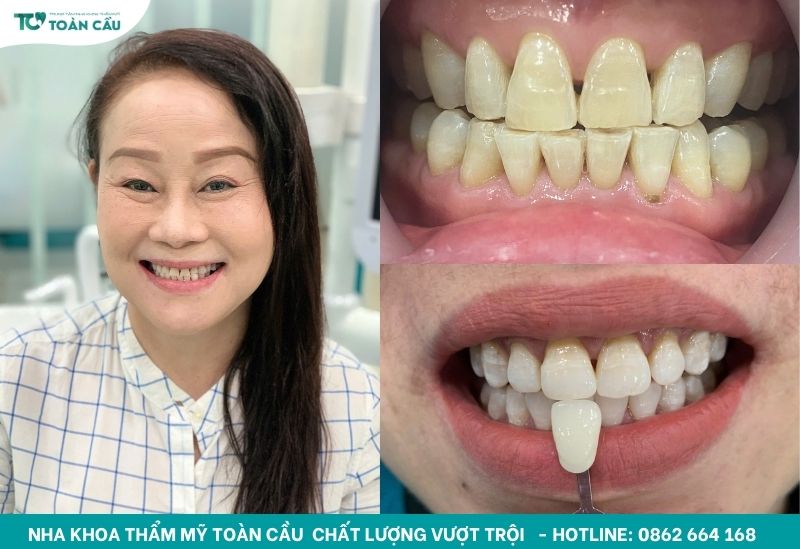 Trước và sau khi tẩy trắng răng