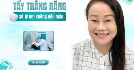 tẩy trắng răng không đều màu