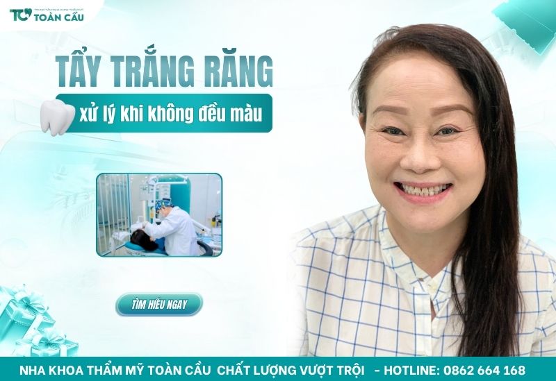 tẩy trắng răng không đều màu