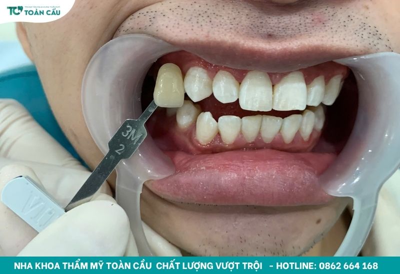 Tẩy trắng răng nên kiêng gì để giữ răng trắng bền lâu? 2 Kiêng cữ sau khi tẩy trắng răng là điều quan trọng