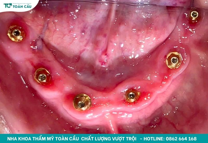 Địa chỉ trồng răng implant nguyên hàm giá rẻ quận Gò Vấp 3 Người cao tuổi mất răng toàn hàm
