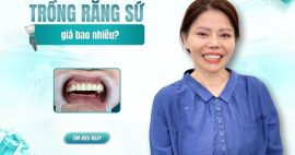 Trồng răng sứ giá bao nhiêu