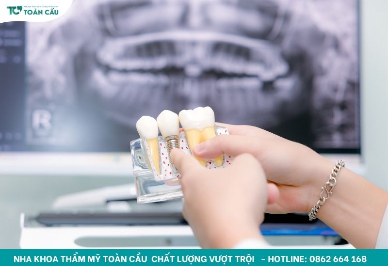 Trồng răng sứ giá bao nhiêu để vừa đẹp vừa bền lâu? 3 Cấy ghép Implant và cầu răng sứ