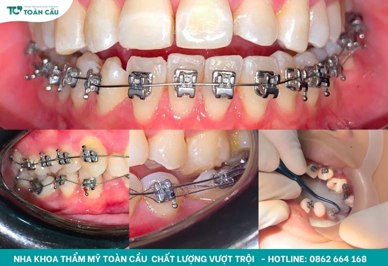Niềng răng mắc cài kim loại