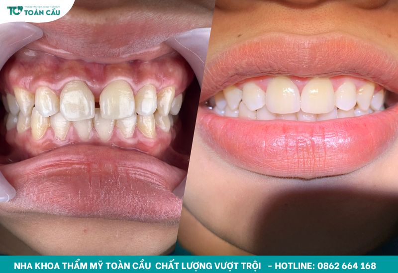Bọc sứ không mài như thế nào và liệu có bền đẹp dài lâu? 3 Hiệu quả của dán sứ veneer