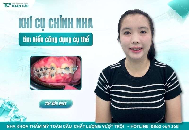 các loại khí cụ chỉnh nha