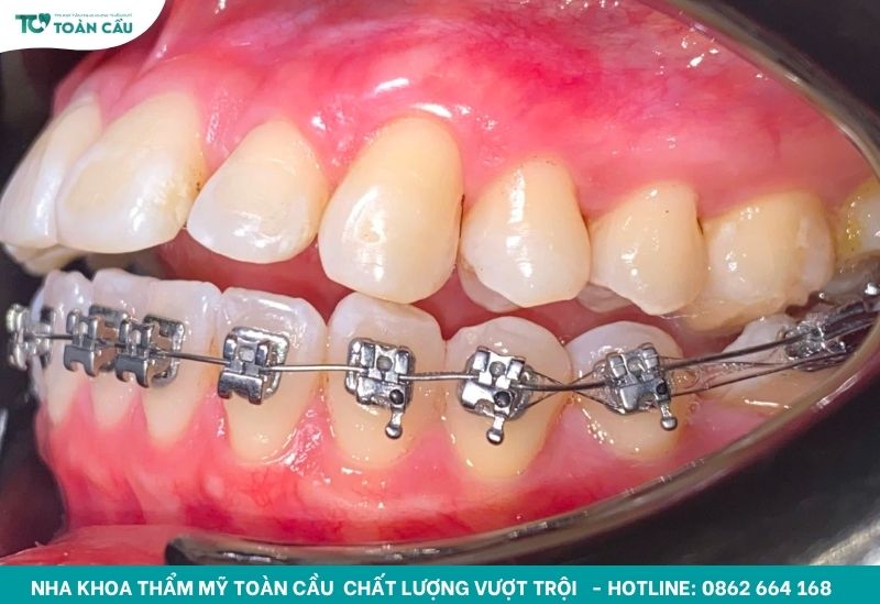 Các loại khí cụ chỉnh nha và công dụng cụ thể từng loại 3 Mắc cài kim loại