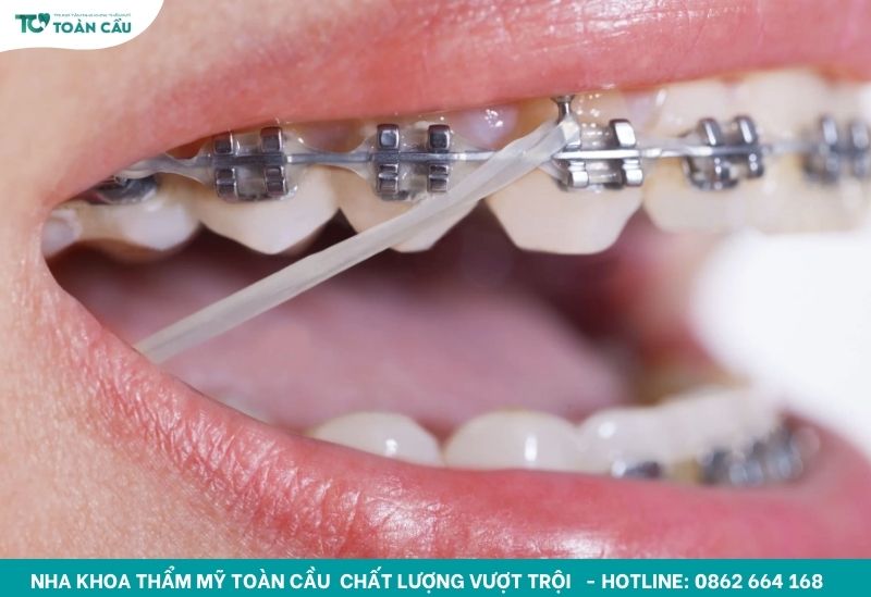 Các loại khí cụ chỉnh nha và công dụng cụ thể từng loại 5 Thun liên hàm