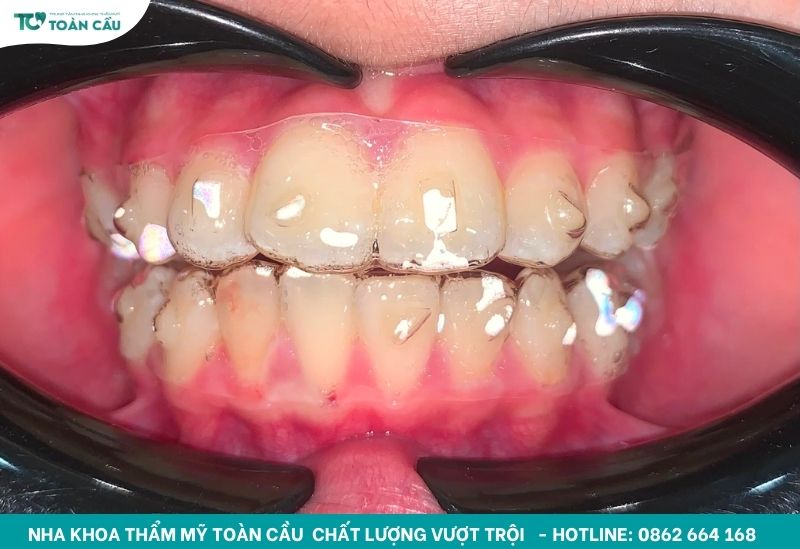 Các loại khí cụ chỉnh nha và công dụng cụ thể từng loại 6 Khay niềng răng trong suốt