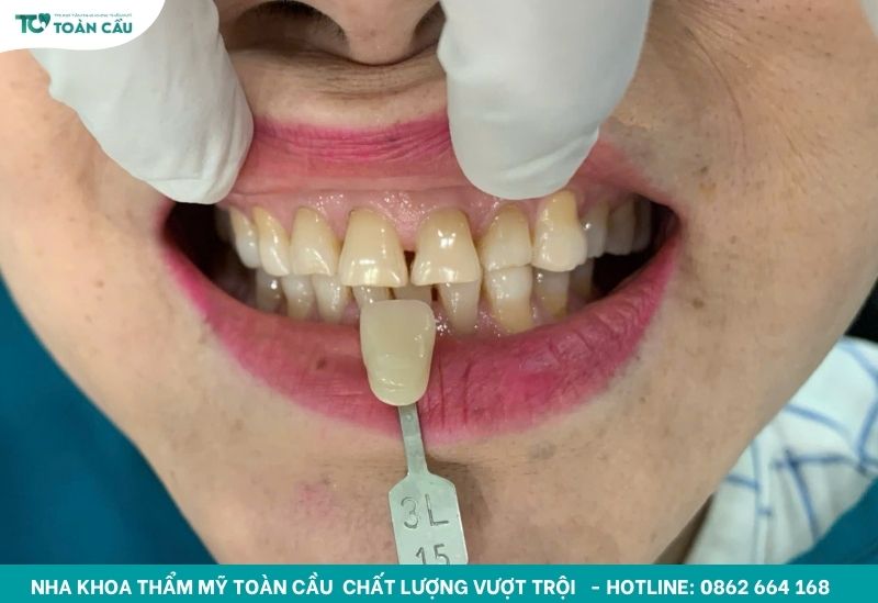 Cách làm trắng răng bị ố vàng lâu năm an toàn và hiệu quả 2 Răng ố vàng lâu năm