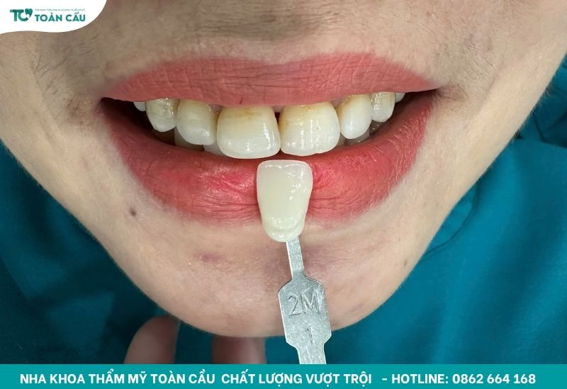 Cách làm trắng răng bị ố vàng lâu năm an toàn và hiệu quả 3 Răng bị ố nhiều ở phía chân răng