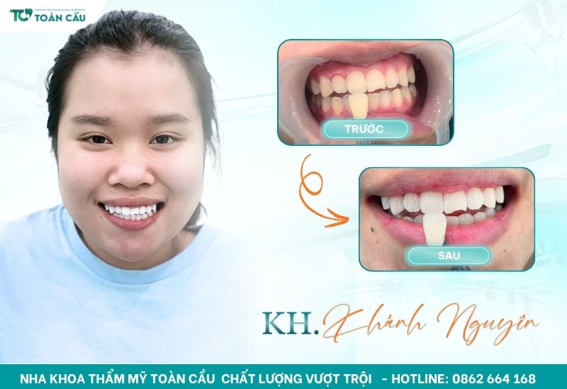 Cách làm trắng răng bị ố vàng lâu năm an toàn và hiệu quả 7 Kết quả tẩy trắng răng 1 lần