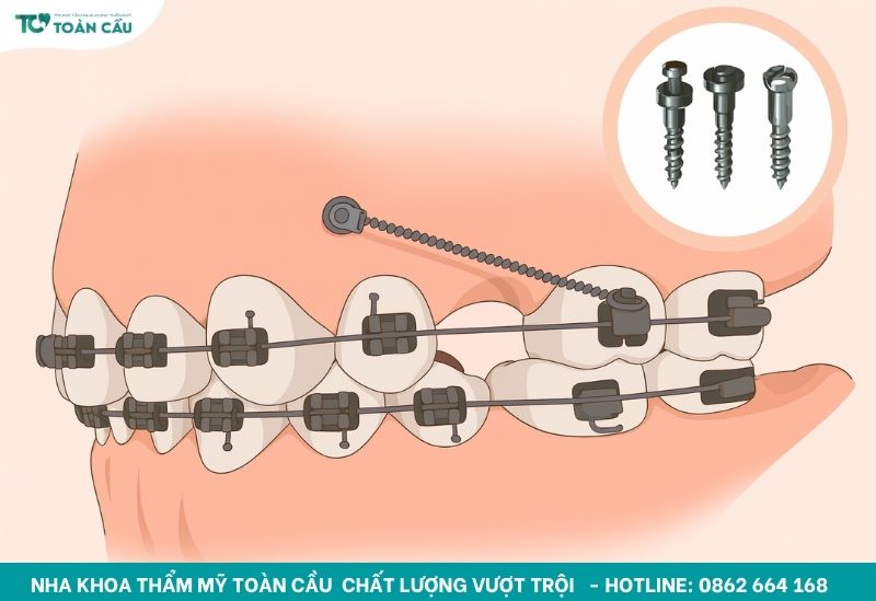 Minivis là gì? Cắm minivis có đau không? 2 Ứng dụng của minivis trong chỉnh nha