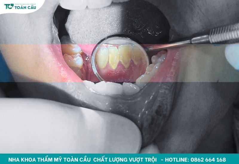 Cao răng tạo thành những mảng bám cứng đầu