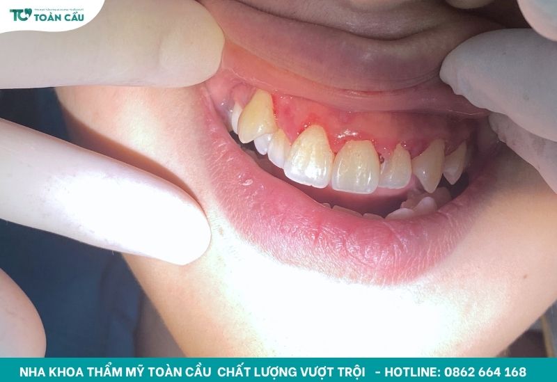 Cao răng được lấy sạch sẽ