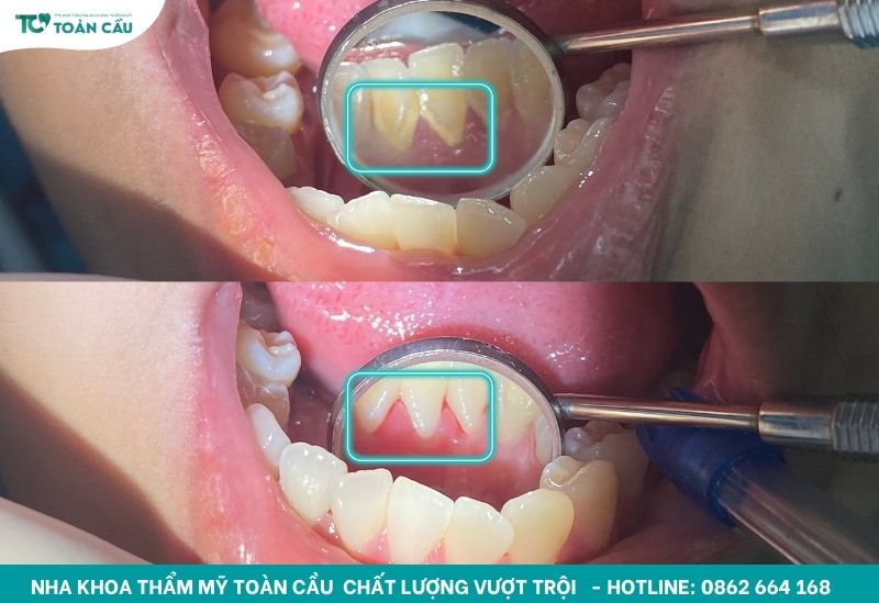Kết quả lấy cao răng tại Toàn Cầu
