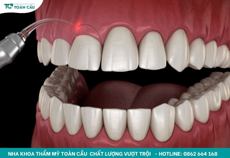 Cắt lợi có đau không? Làm trong bao lâu thì xong? 2 Cắt lợi laser