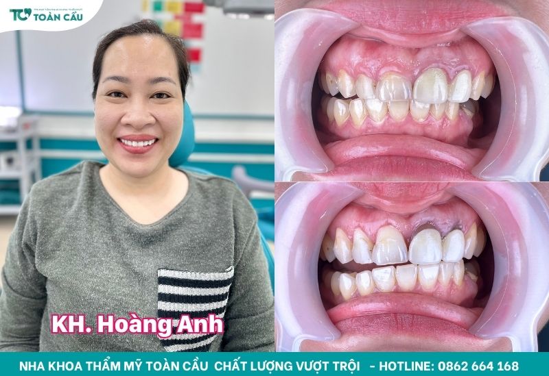 Cắt lợi có đau không? Làm trong bao lâu thì xong? 4 Khách hàng Hoàng Anh cắt lợi tại Toàn Cầu