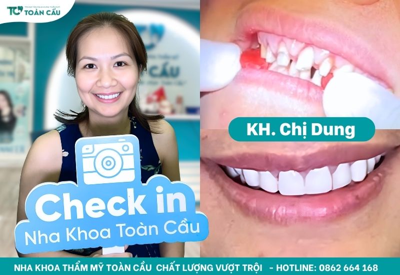 Cắt lợi có đau không? Làm trong bao lâu thì xong? 5 Chị Dung cắt lợi và bọc sứ