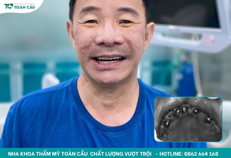 5 bước chăm sóc răng sau khi trồng implant tại nhà 7 Khách hàng trồng implant tại Toàn Cầu
