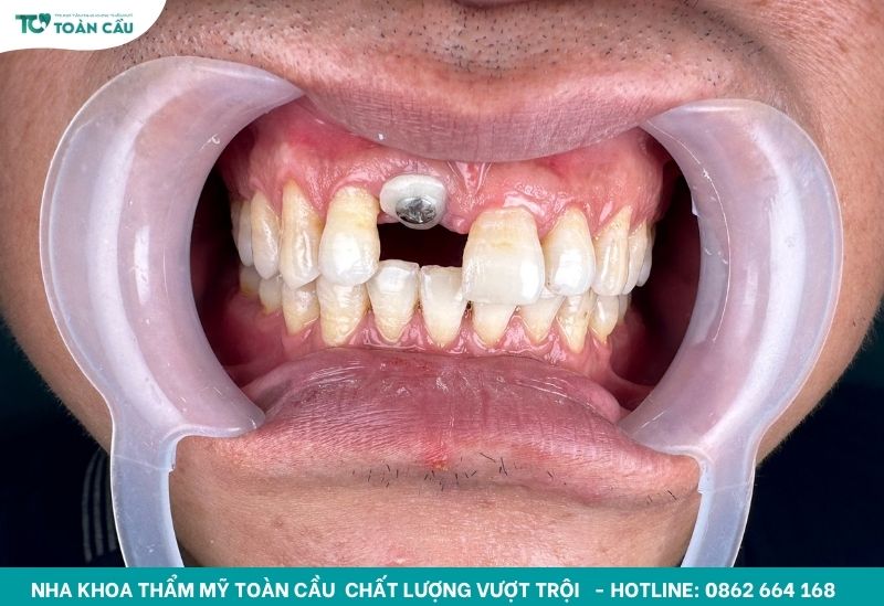 Chi phí trồng 2 răng cửa bằng trụ implant là bao nhiêu? 2 Hình ảnh khách trồng răng cửa