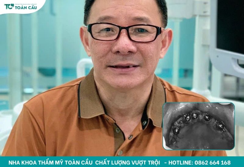 Chi phí trồng 2 răng cửa bằng trụ implant là bao nhiêu? 7 Khách hàng cắm implant All-on-5