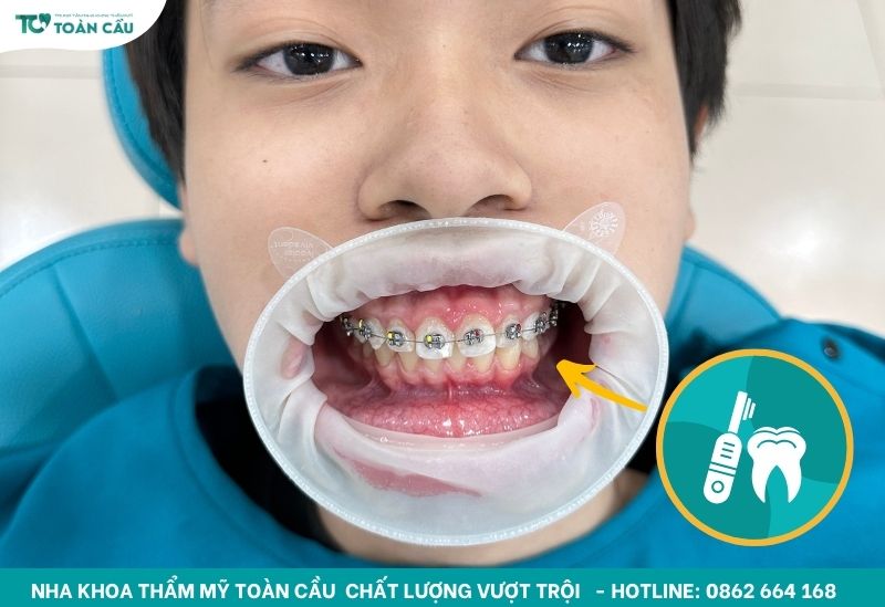Toàn Cầu giải đáp có nên dùng bàn chải điện không? 4 Bàn chải điện vệ sinh sạch sẽ mắc cài