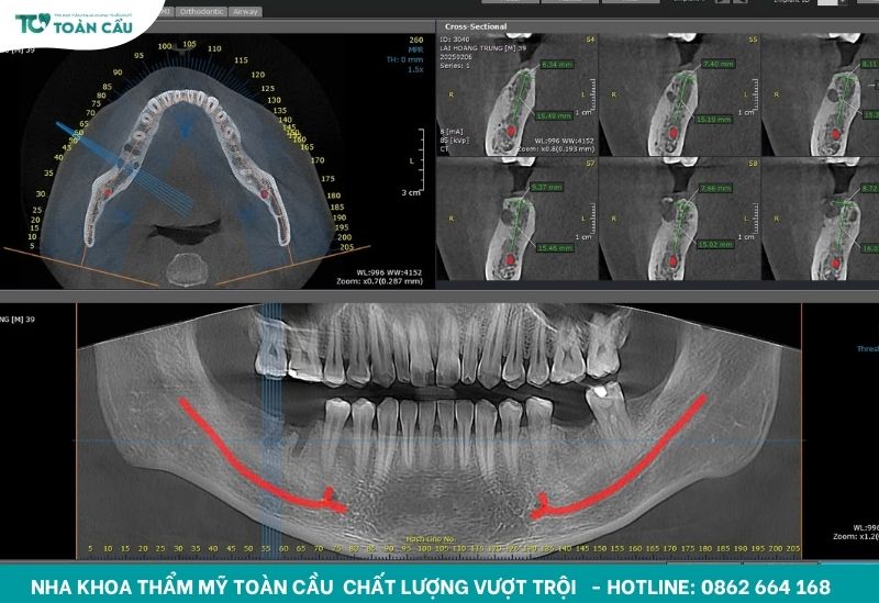 Dấu hiệu Implant bị đào thải mà bạn không nên chủ quan 4 Hình ảnh Implant qua CT Conebeam 3D