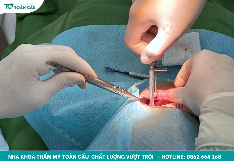 Dấu hiệu Implant bị đào thải mà bạn không nên chủ quan 7 Cấy ghép Implant đạt chuẩn tại Nha khoa Toàn Cầu