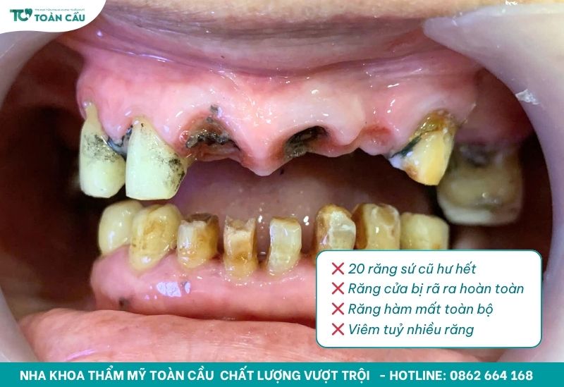 Cảnh báo những dấu hiệu răng sứ bị hư bạn cần biết sớm 2 Răng sứ của khách hàng bị hỏng