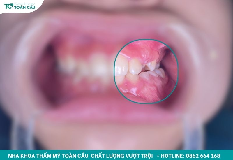 Đóng khoảng trong niềng răng bao lâu thì thấy kết quả rõ? 2 Đóng khoảng điều chỉnh khoảng trống nhổ răng