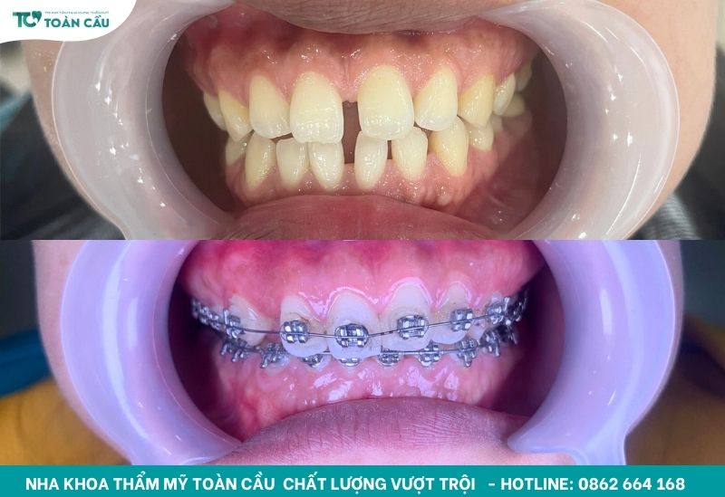 Đóng khoảng trong niềng răng bao lâu thì thấy kết quả rõ? 3 Đóng khoảng khép khoảng trống răng