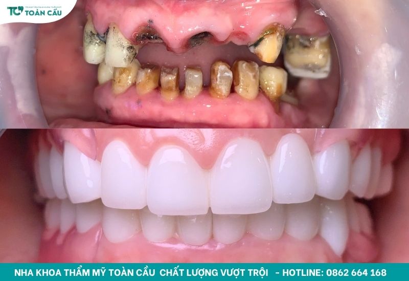 Bảng giá làm răng sứ nguyên hàm TPHCM cập nhật mới nhất 6 Kết quả làm răng sứ tại Toàn Cầu