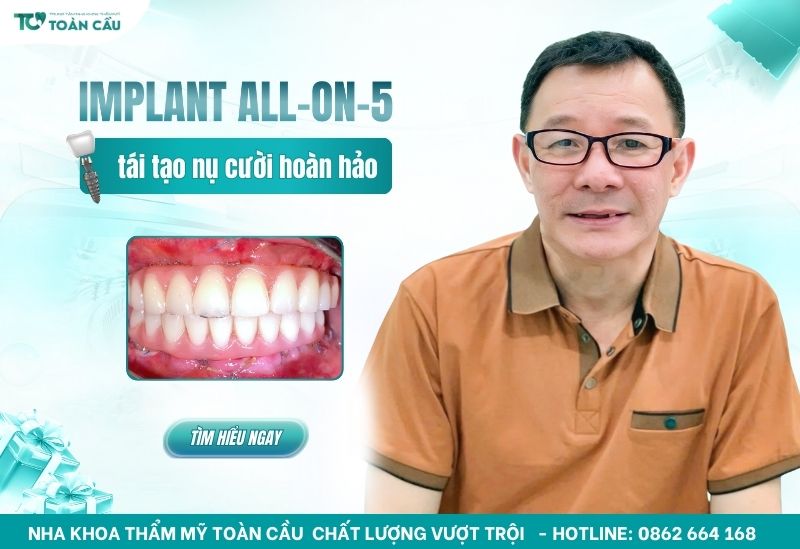 implant toàn hàm All on 5