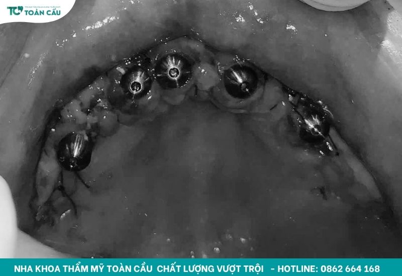Tái tạo nụ cười hoàn hảo cùng implant toàn hàm All on 5 2 Implant toàn hàm All on 5