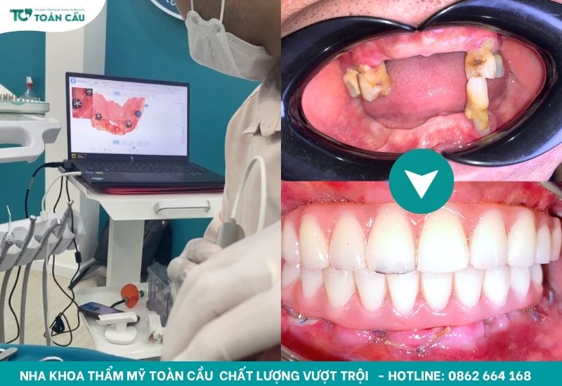 Tái tạo nụ cười hoàn hảo cùng implant toàn hàm All on 5 4 Quá trình điều trị của chú Thuận