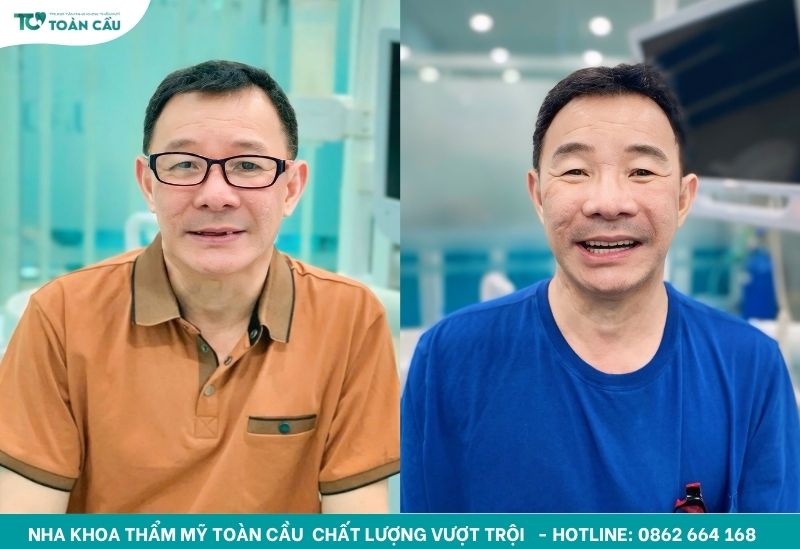 Tái tạo nụ cười hoàn hảo cùng implant toàn hàm All on 5 5 Chú Thuận hài lòng sau điều trị