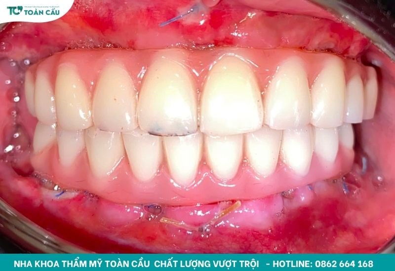 Làm răng Implant trong bao lâu thì hoàn tất? 3 Răng tạm trong làm răng implant