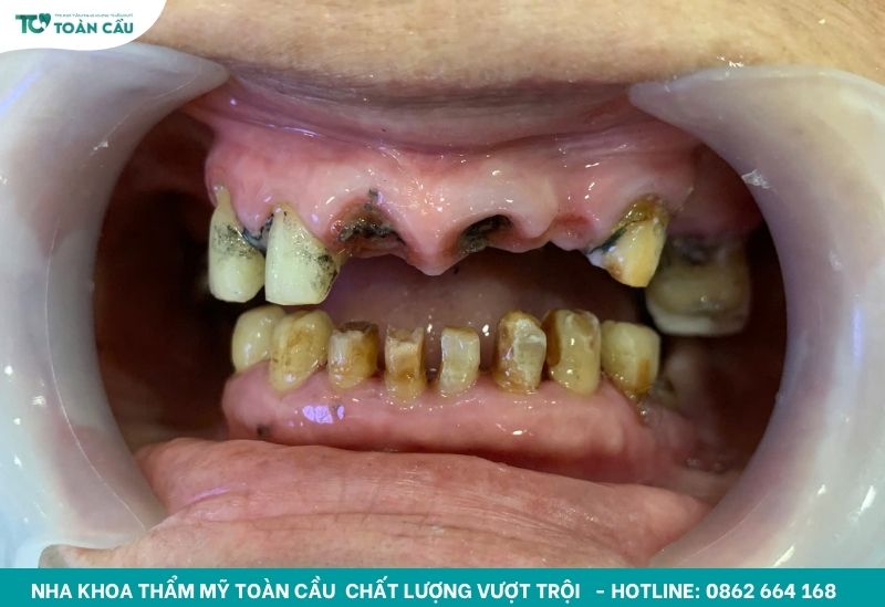 Làm răng sứ bị sai khớp cắn có sửa được không? 2 Khách hàng làm răng sứ bị sai khớp cắn không điều trị sớm